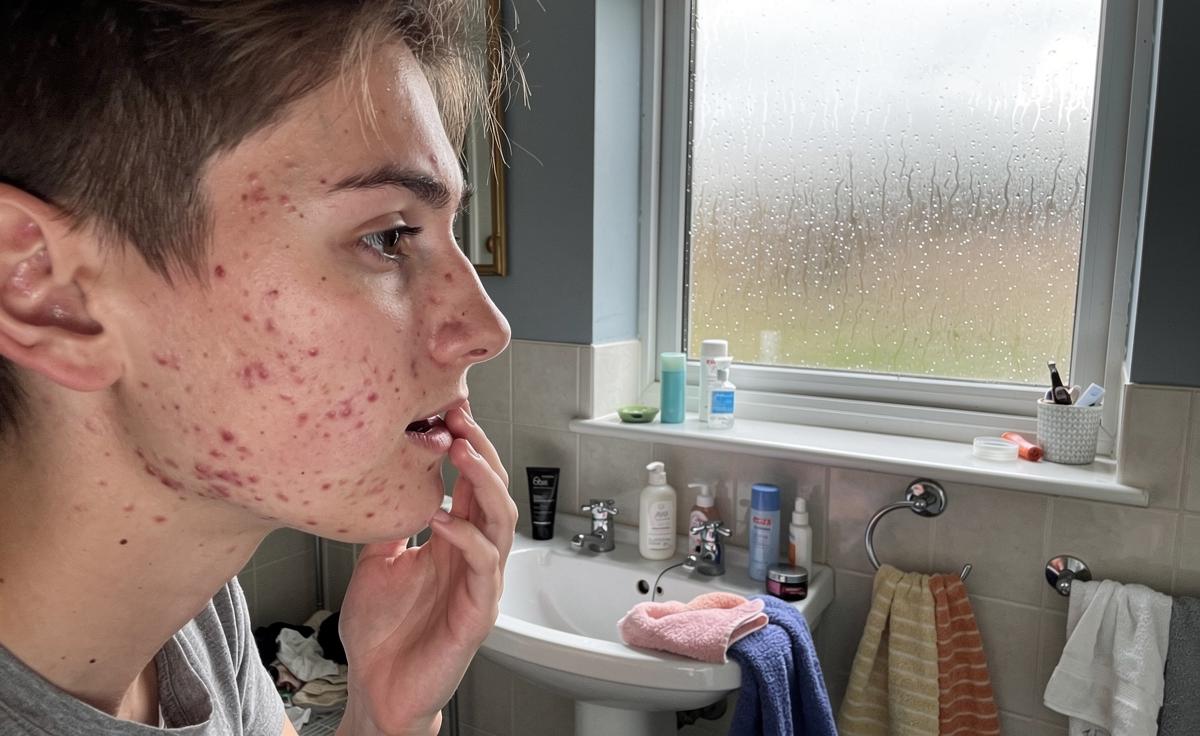 Skincare SOS: Tackling Breakouts in the UK’s Climate